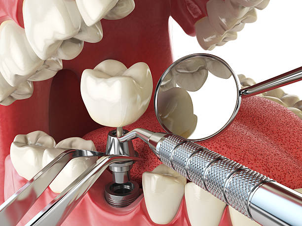 Best Broken or Cracked Tooth Emergency Dentist in Tipton, IA